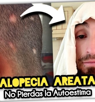 (ALOPECIA AREATA) Como logré ELIMINARLA en unos Meses con H&S Prevención Caída by mixim89